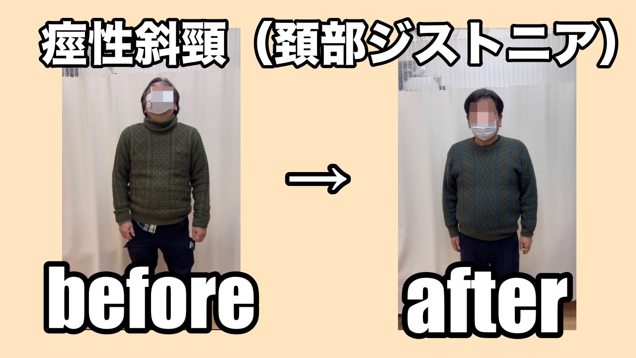 痙性斜頸　勝手に上を向く　ジストニア